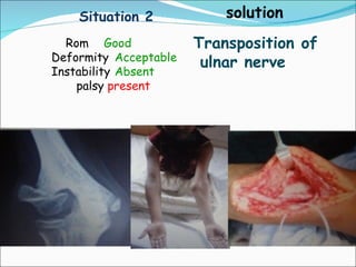 Situation 2            solution
  Rom Good             Transposition of
Deformity Acceptable    ulnar nerve
Instability Absent
    palsy present
 