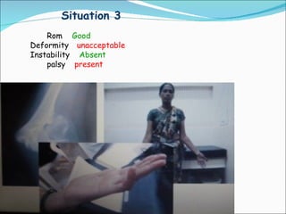 Situation 3
    Rom Good
Deformity unacceptable
Instability Absent
    palsy present
 