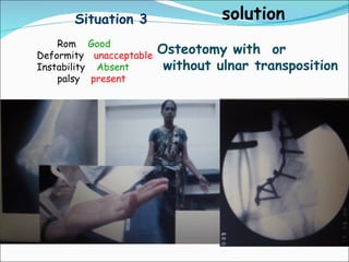 Situation 3                 solution
    Rom Good
Deformity unacceptable
                         Osteotomy with or
Instability Absent        without ulnar transposition
    palsy present
 