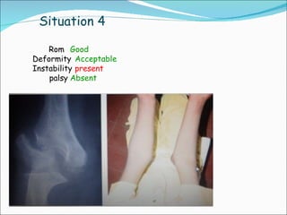 Situation 4

    Rom Good
Deformity Acceptable
Instability present
    palsy Absent
 