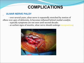 COMPLICATIONS
-
    ULNAR NERVE PALSY
      - over several years, ulnar nerve is repeatedly stretched by motion of
elbow over apex of deformity, & becomes inflamed behind medial condyle;
      - typically symptoms are not seen until second decade;
      - at earliest signs of neuritis, ulnar nerve should undergo transposition;
 