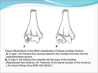 Figure 2Illustrations of the Milch classification of lateral condylar fracture.
A, In type I, the fracture line courses lateral to the trochlea and exits into the
capitulotrochlear groove.
B, In type II, the fracture line extends into the apex of the trochlea.
(Reproduced from Sullivan JA: Fractures of the lateral condyle of the humerus.
J Am Acad Orthop Surg 2006;14[1]:58-62.)
 
