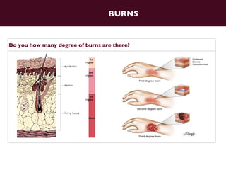Burns 