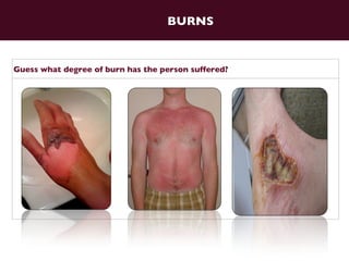 Do you how many degree of burns are there?    BURNS 