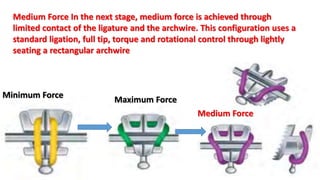 Medium Force In the next stage, medium force is achieved through
limited contact of the ligature and the archwire. This configuration uses a
standard ligation, full tip, torque and rotational control through lightly
seating a rectangular archwire
Minimum Force Maximum Force
Medium Force
 