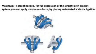 Maximum + Force If needed, for full expression of the straight arch bracket
system, you can apply maximum + force, by placing an inverted V elastic ligation
 