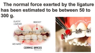 The normal force exerted by the ligature
has been estimated to be between 50 to
300 g.
 