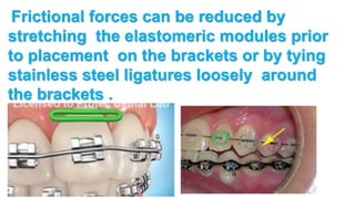 Frictional forces can be reduced by
stretching the elastomeric modules prior
to placement on the brackets or by tying
stainless steel ligatures loosely around
the brackets .
 