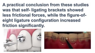 A practical conclusion from these studies
was that self- ligating brackets showed
less frictional forces, while the figure-of-
eight ligature configuration increased
friction significantly.
 