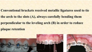 Conventional brackets received metallic ligatures used to tie
the arch to the slots (A), always carefully bending them
perpendicular to the leveling arch (B) in order to reduce
plaque retention
 