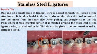 Stainless Steel Ligatures
Double Tie
One end of a small piece of ligature wire is passed through the lumen of the
attachment. It is taken labial to the arch wire on the other side and reinserted
into the lumen from the same side. After pulling out completely to the side
from where it was inserted earlier, it is twisted around the other end of the
ligature wire, cut and tucked in. This tie can be given to correct rotation and to
upright a tooth.
 