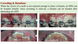 Crowding & Rotations
When the crown of a tooth is not exposed enough to place a bracket, an MPA can
be bonded initially. Once crowding is relieved, a bracket can be bonded after
debonding the MPA
 