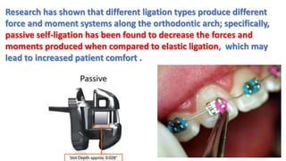 Research has shown that different ligation types produce different
force and moment systems along the orthodontic arch; specifically,
passive self-ligation has been found to decrease the forces and
moments produced when compared to elastic ligation, which may
lead to increased patient comfort .
 