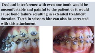 Occlusal interference with even one tooth would be
uncomfortable and painful to the patient or it would
cause bond failure resulting in extended treatment
duration. Teeth in scissors bite can also be corrected
with this attachment
 