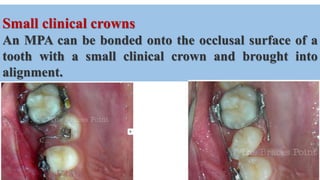 Small clinical crowns
An MPA can be bonded onto the occlusal surface of a
tooth with a small clinical crown and brought into
alignment.
 