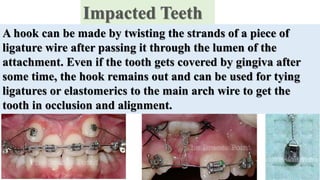 A hook can be made by twisting the strands of a piece of
ligature wire after passing it through the lumen of the
attachment. Even if the tooth gets covered by gingiva after
some time, the hook remains out and can be used for tying
ligatures or elastomerics to the main arch wire to get the
tooth in occlusion and alignment.
Impacted Teeth
 