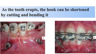 As the tooth erupts, the hook can be shortened
by cutting and bending it
 
