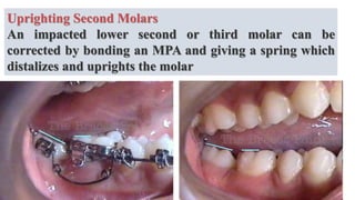 Uprighting Second Molars
An impacted lower second or third molar can be
corrected by bonding an MPA and giving a spring which
distalizes and uprights the molar
 