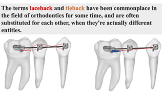 The terms laceback and tieback have been commonplace in
the field of orthodontics for some time, and are often
substituted for each other, when they're actually different
entities.
 