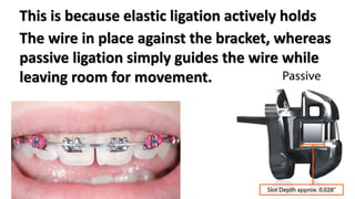 This is because elastic ligation actively holds
The wire in place against the bracket, whereas
passive ligation simply guides the wire while
leaving room for movement.
 