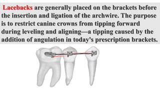 Lacebacks are generally placed on the brackets before
the insertion and ligation of the archwire. The purpose
is to restrict canine crowns from tipping forward
during leveling and aligning—a tipping caused by the
addition of angulation in today's prescription brackets.
 
