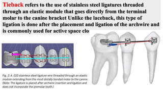 Tieback refers to the use of stainless steel ligatures threaded
through an elastic module that goes directly from the terminal
molar to the canine bracket Unlike the laceback, this type of
ligation is done after the placement and ligation of the archwire and
is commonly used for active space closure.
 