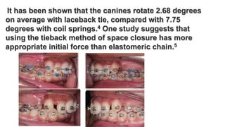 It has been shown that the canines rotate 2.68 degrees
on average with laceback tie, compared with 7.75
degrees with coil springs.4 One study suggests that
using the tieback method of space closure has more
appropriate initial force than elastomeric chain.5
 