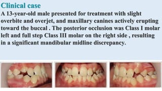 Clinical case
A 13-year-old male presented for treatment with slight
overbite and overjet, and maxillary canines actively erupting
toward the buccal . The posterior occlusion was Class I molar
left and full step Class III molar on the right side , resulting
in a significant mandibular midline discrepancy.
 