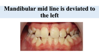 Mandibular mid line is deviated to
the left
 