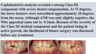 Cephalometric analysis revealed a strong Class III
component with severe dental compensation. At 73 degrees,
the lower incisors were retroclined approximately 20 degrees
from the norm. Although ANB was only slightly negative, the
Wits appraisal came out to -9.3mm. Because of the severity of
the Class III skeletal component and the patient being in
active growth, the likelihood of future surgery was discussed
before any treatment.
 