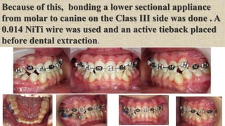 Because of this, bonding a lower sectional appliance
from molar to canine on the Class III side was done . A
0.014 NiTi wire was used and an active tieback placed
before dental extraction.
 