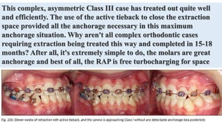This complex, asymmetric Class III case has treated out quite well
and efficiently. The use of the active tieback to close the extraction
space provided all the anchorage necessary in this maximum
anchorage situation. Why aren't all complex orthodontic cases
requiring extraction being treated this way and completed in 15-18
months? After all, it's extremely simple to do, the molars are great
anchorage and best of all, the RAP is free turbocharging for space
closure.
 