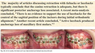 The majority of articles discussing retraction with tiebacks or lacebacks
typically conclude that the canine retraction is adequate, but there is
significant posterior anchorage loss associated. A recent meta-analysis
concluded, "There is no evidence to support the use of lacebacks for the
control of the sagittal position of the incisors during initial orthodontic
alignment." Another recent article concluded, "Active laceback produced
anchorage loss of maxillary first molars."3
 