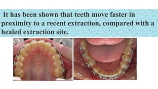 It has been shown that teeth move faster in
proximity to a recent extraction, compared with a
healed extraction site.
 