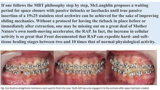 If one follows the MBT philosophy step by step, McLaughlin proposes a waiting
period for space closure with passive tiebacks or lacebacks until true passive
insertion of a 19x25 stainless steel archwire can be achieved for the sake of improving
sliding mechanics. Without a protocol for having the tieback in place before or
immediately after extraction, one may be missing out on a great deal of Mother
Nature's own tooth-moving accelerator, the RAP. In fact, the increase in cellular
activity is so great that Frost documented that RAP can expedite hard- and soft-
tissue healing stages between two and 10 times that of normal physiological activity.
 