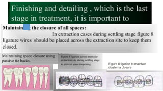 Figure 8 ligation to maintain
diastema closure
 