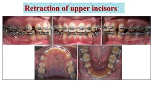 Retraction of upper incisors
 