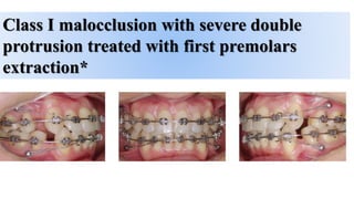 Class I malocclusion with severe double
protrusion treated with first premolars
extraction*
 