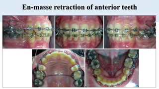 En-masse retraction of anterior teeth
 