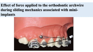 Effect of force applied to the orthodontic archwire
during sliding mechanics associated with mini-
implants.
 