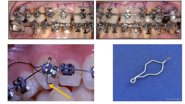 Types Of Ligation Types Of Ligation Ties – Stainless steel ligatures in orthodontic ...