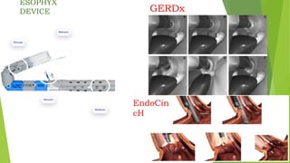 ESOPHYX
DEVICE GERDx
EndoCin
cH
 