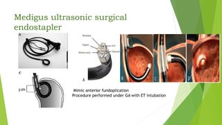 Medigus ultrasonic surgical
endostapler
Mimic anterior fundoplication
Procedure performed under GA with ET intubation
 