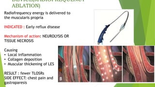 DEVICE(RADIOFREQUENCY
ABLATION)
Radiofrequency energy is delivered to
the muscularis propria
INDICATED : Early reflux disease
Mechanism of action: NEUROLYSIS OR
TISSUE NECROSIS
Causing
• Local inflammation
• Collagen deposition
• Muscular thickening of LES
RESULT : fewer TLOSRs
SIDE EFFECT: chest pain and
gastroparesis
 