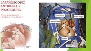 LAPAROSCOPIC
ANTIREFLUX
PROCEDURE
Nissen fundoplications
(360degree)-gold standard
 