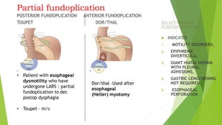 Partial fundoplication
POSTERIOR FUNDOPLICATION ANTERIOR FUNDOPLICATION
TOUPET DOR/THAL BELSEY MARK IV
FUNDOPLICATION
 INDICATED
1. MOTILITY DISORDERS,
2. EPIPHRENIC
DIVERTICULA,
3. GIANT HIATAL HERNIA
WITH PLEURAL
ADHESIONS,
4. GASTRIC LENGTHENING
NOT REQUIRED,
5. ESOPHAGEAL
PERFORATION
• Patient with esophageal
dysmotility who have
undergone LARS : partial
fundoplication to dec
postop dysphagia
• Toupet – m/c
Dor/thal –Used after
esophageal
(Heller) myotomy
 