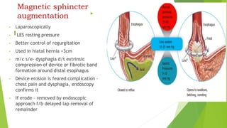 Magnetic sphincter
augmentation 
• Laparoscopically
• LES resting pressure
• Better control of regurgitation
• Used in hiatal hernia >3cm
• m/c s/e- dysphagia d/t extrinsic
compression of device or fibrotic band
formation around distal esophagus
• Device erosion is feared complication –
chest pain and dysphagia, endoscopy
confirms it
• If erode – removed by endoscopic
approach f/b delayed lap removal of
remainder
 