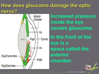 How does glaucoma damage the optic nerve?  Increased pressure inside the eye causes glaucoma.  In the front of the eye is a  space called the anterior  chamber.  