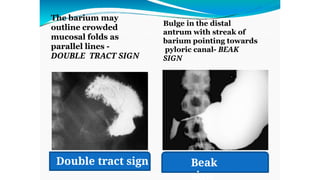final goo and its management and complications .pptx