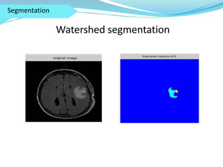 Automatic System for Detection and Classification of Brain Tumors | PPTX